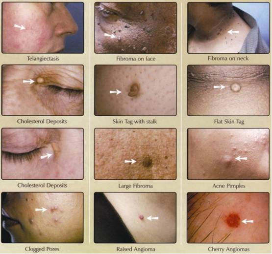skin lesion removals